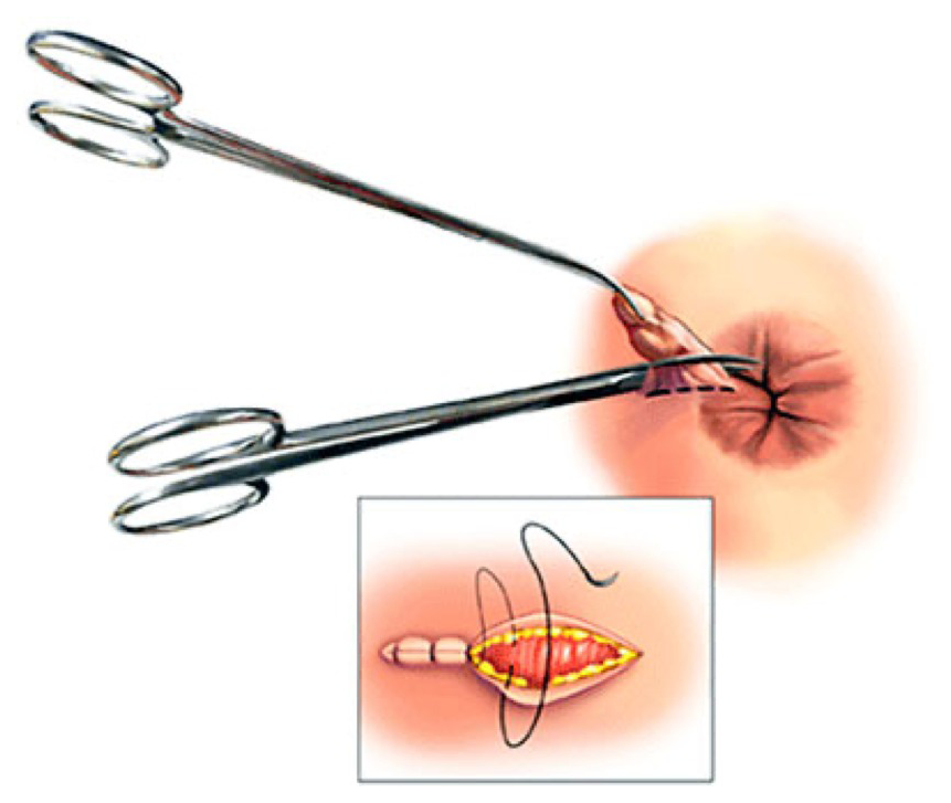 Plicomas sp especialista