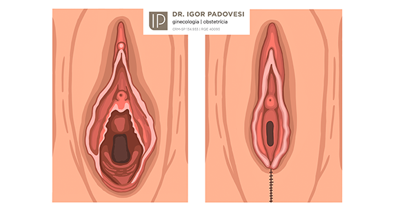 perineoplastia sp especialista